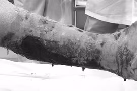 Biến chứng hoại tử nguy kịch, sai lầm trong xử lý vết thương tại nhà