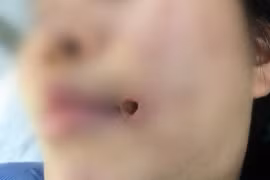 Cô gái 21 tuổi không thể há miệng vì biến chứng sau tiêm filler