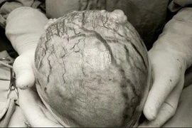 U khủng như thai 3 tháng do dùng thực phẩm chức năng 