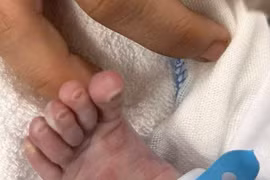 Một ca bệnh giang mai sơ sinh khiến bác sĩ day dứt