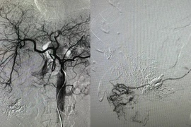 Đau bụng dữ dội người đàn ông 39 tuổi vỡ u gan