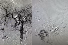 Đau bụng dữ dội người đàn ông 39 tuổi vỡ u gan