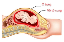 Sản phụ 23 tuổi vỡ tử cung nguy kịch vì ngại khám thai