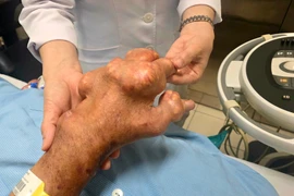 Cách thay đổi lối sống để tránh cơn đau gút