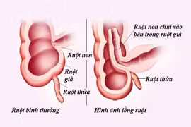 Trẻ khóc bất thường cẩn thận lồng ruột nguy hiểm