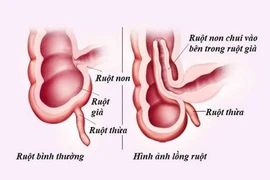 Trẻ khóc bất thường cẩn thận lồng ruột nguy hiểm