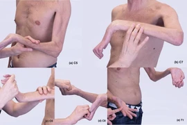 Cách điều trị liệt đám rối thần kinh cánh tay