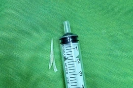 Nuốt đau, ứ đọng nước bọt, phát hiện xương cá 2 chạc sắc nhọn trong thực quản