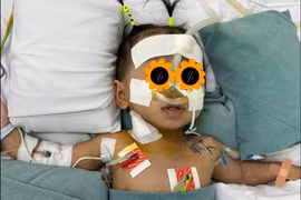 Tuần hoàn ngoài cơ thể cứu trẻ 8kg viêm phổi nặng do Adenovirus 