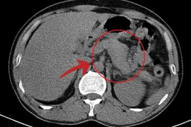 Lạm dụng rượu bia, người đàn ông 47 tuổi viêm tụy cấp