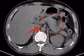 Lạm dụng rượu bia, người đàn ông 47 tuổi viêm tụy cấp
