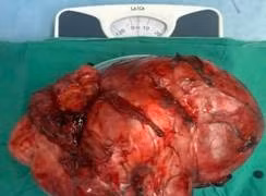 Lấy u GIST đại tràng nặng 5kg choáng hết ổ bụng người đàn ông ở Thanh Hóa