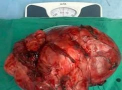 Lấy u GIST đại tràng nặng 5kg choáng hết ổ bụng người đàn ông ở Thanh Hóa