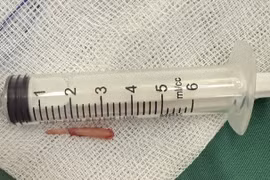 Hiếm gặp, xương mỏm trâm thái dương dài bất thường gây vướng họng, nuốt vướng