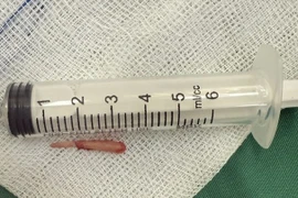 Hiếm gặp, xương mỏm trâm thái dương dài bất thường gây vướng họng, nuốt vướng