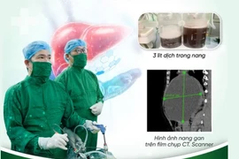 Nang gan lành tính thường bị bỏ qua nhưng có thể đe dọa tính mạng