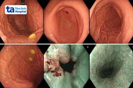 Thường xuyên đau bụng, trẻ 6 tuổi có nhiều ổ loét dạ dày tá tràng