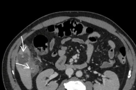 Người đàn ông 58 tuổi áp xe gan vì nuốt phải xương cá
