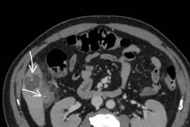 Người đàn ông 58 tuổi áp xe gan vì nuốt phải xương cá