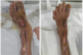 Hôn mê, viêm màng não... vì tự nặn mủ ngón chân