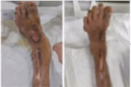 Hôn mê, viêm màng não... vì tự nặn mủ ngón chân