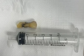 Nội soi gắp dị vật trong phế quản gốc của bệnh nhân