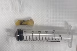 Nội soi gắp dị vật trong phế quản gốc của bệnh nhân