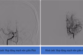 Liệt nửa người do nhồi máu não Moyamoya hiếm gặp