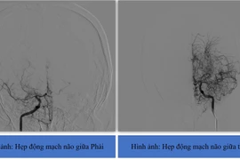 Liệt nửa người do nhồi máu não Moyamoya hiếm gặp