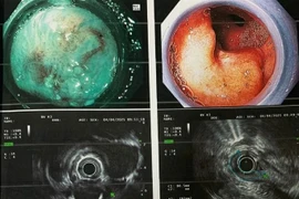 Người đàn ông cùng lúc phát hiện mắc hai bệnh ung thư