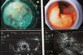 Người đàn ông cùng lúc phát hiện mắc hai bệnh ung thư