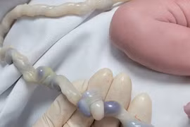 Bé 2,6 kg dây rốn thắt nút được sinh thường an toàn nhờ theo dõi đúng