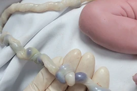 Bé 2,6 kg dây rốn thắt nút được sinh thường an toàn nhờ theo dõi đúng