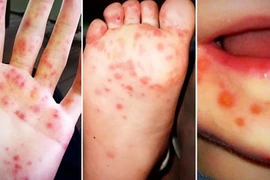 Gia tăng bệnh tay chân miệng, cần biết cách phòng ngừa