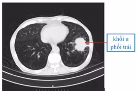 Cùng lúc phát hiện nhiều bệnh nguy kịch vì không khám sức khỏe định kỳ