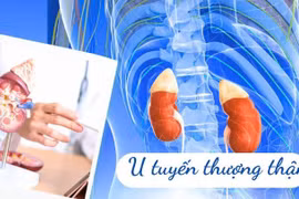 U tuyến thượng thận – khối u nhỏ nhưng hậu quả khôn lường