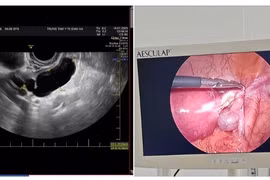 Người phụ nữ 47 tuổi nguy kịch vì đau bụng do ứ mủ vòi trứng