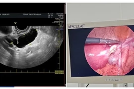 Người phụ nữ 47 tuổi nguy kịch vì đau bụng do ứ mủ vòi trứng