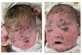 Cảnh giác biến chứng nặng do điều trị viêm da cơ địa, viêm da đầu sai cách 