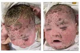 Cảnh giác biến chứng nặng do điều trị viêm da cơ địa, viêm da đầu sai cách 