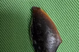 Viêm phổi kéo dài do hạt hồng xiêm mắc sâu ở thùy dưới phổi phải