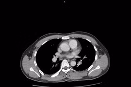 Đau hông lưng, tiểu gắt, bệnh nhân 34 tuổi nguy kịch vì thận ứ mủ