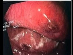 Sốt cao vi khuẩn tấn công thực quản gây suy đa tạng, sốc nhiễm khuẩn