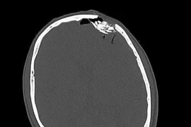 Không đội mũ bảo hiểm, bị gạch rơi vào trán lún xương sọ đe dọa tính mạng