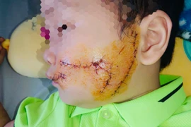 Bé 5 tuổi bị chó cắn vùng mặt, cảnh báo nguy cơ bệnh dại