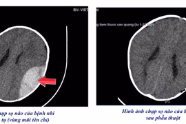 Ngã xe tập đi trẻ 8 tháng tuổi mở sọ cấp cứu giành lại sự sống