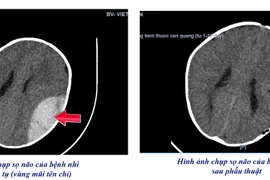Ngã xe tập đi trẻ 8 tháng tuổi mở sọ cấp cứu giành lại sự sống