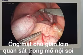 Bẩm sinh nang ống mật chủ gây nhiều biến chứng nguy hiểm