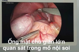 Bẩm sinh nang ống mật chủ gây nhiều biến chứng nguy hiểm