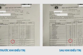 Đau xương cụ ông 78 tuổi không ngờ đa u tủy xương